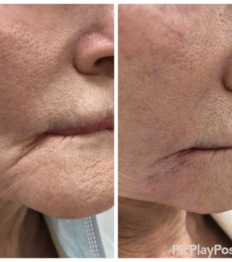 Restylane Defyne Cosmetic Filler