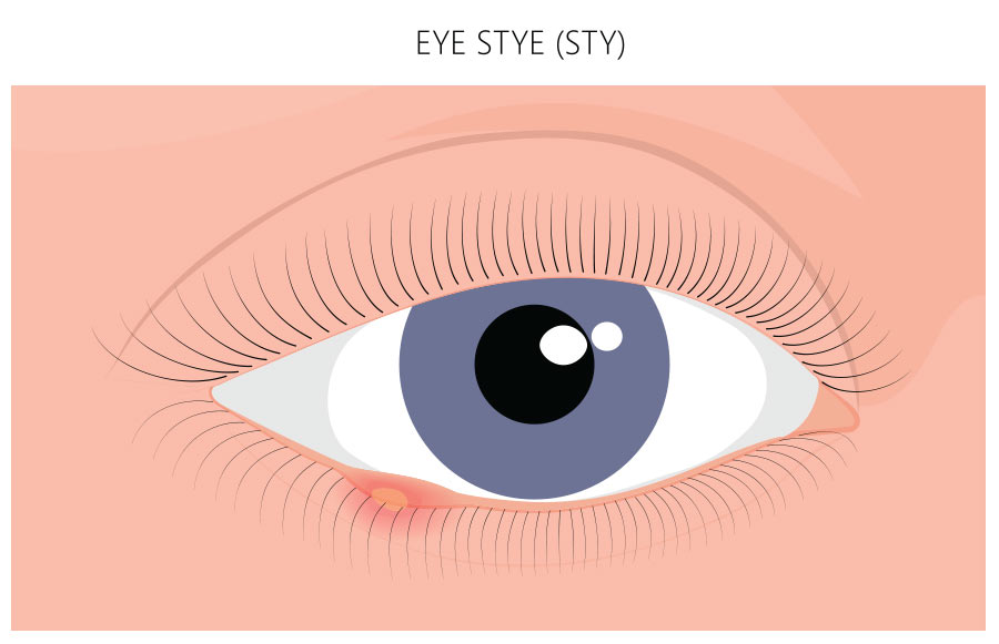 What is a Stye? What is a Chalazion? Treatment for Styes