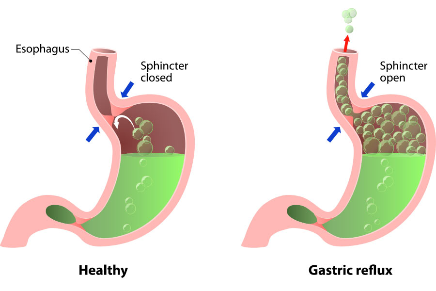 Acid Reflux Reflux Treatment At CEENTA