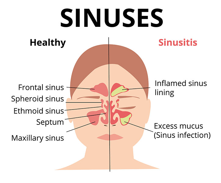 Sinusitis (Sinus Infection) - Symptoms & Causes