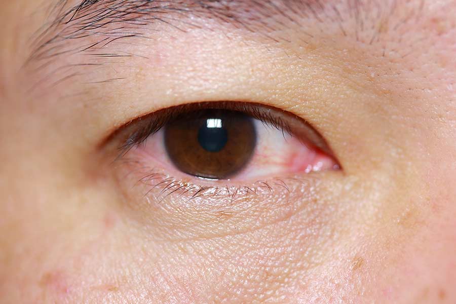 Pink Eye & Eye Infections | Conjunctivitis