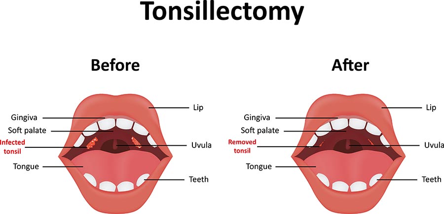 Tonsils and adenoids, tonsil removal, adenoids and tonsils, infected tonsil, enlarged tonsils